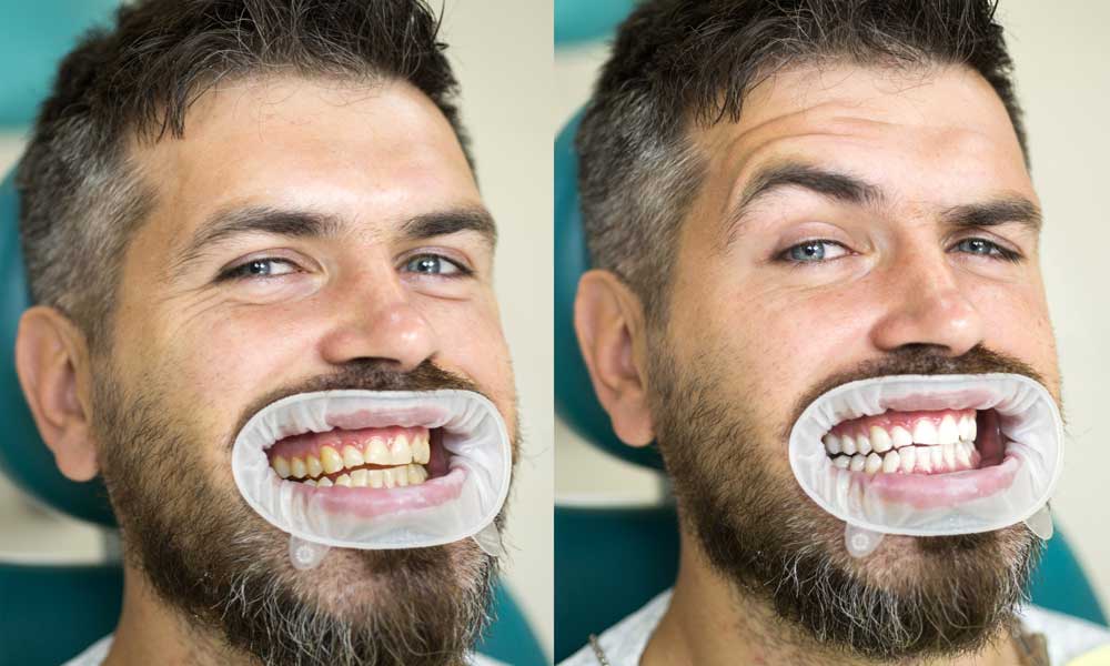 Featured image for “Say Goodbye to Yellow Teeth: A Guide to Teeth Whitening Services”